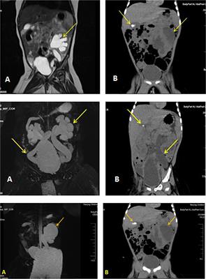 Transient pseudohypoaldosteronism in infancy mainly manifested as poor appetite and vomiting: Two case reports and review of the literature